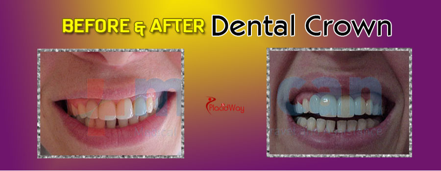 Dental Crowns in Colombia Before and After
